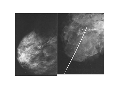 Mammografide görülen şüpheli alanın kılavuz tel ile işaretlenmesi